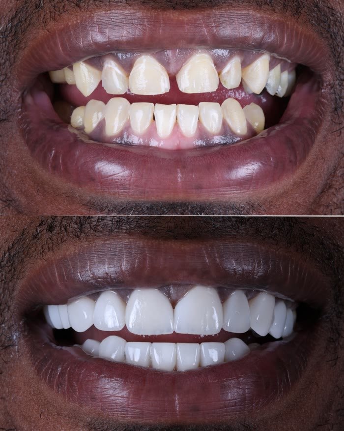Real patient veneers before and after