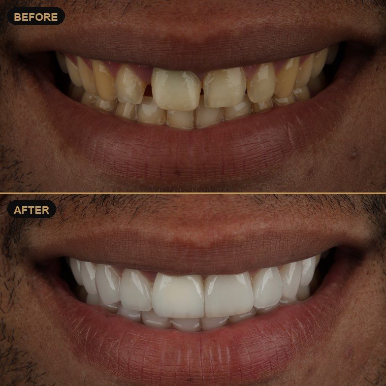 Antes y después de carillas dentales — Lael Dental Esthetic