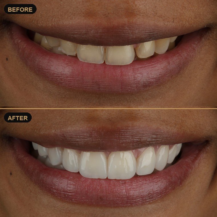 Antes y después de carillas dentales — Lael Dental Esthetic