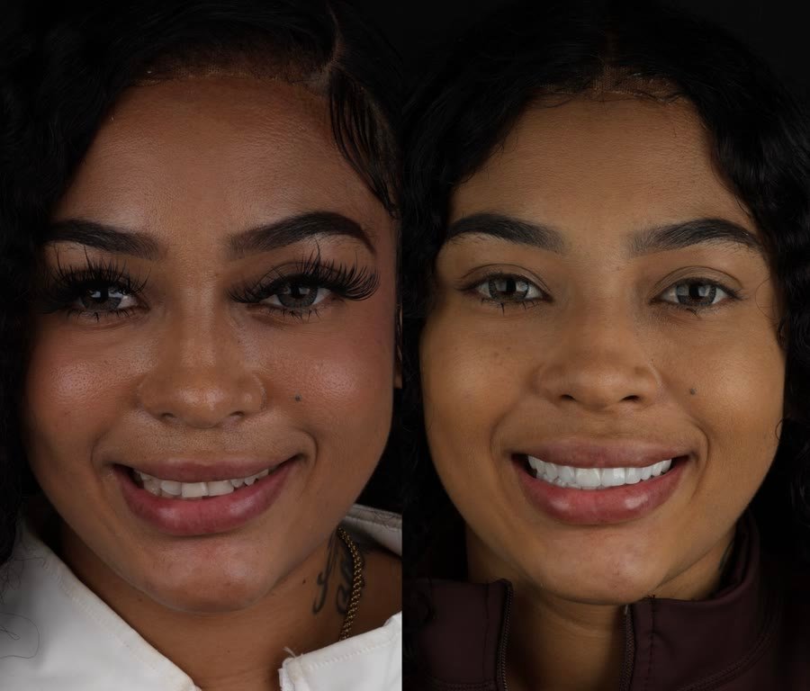 Real patient before and after porcelain veneers