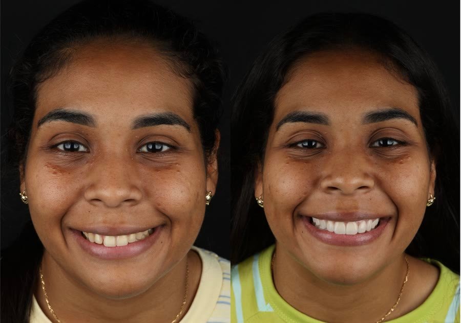 Real patient before and after porcelain veneers