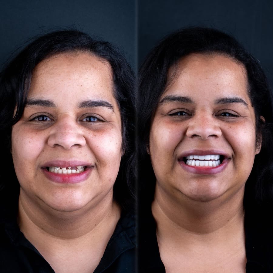 Real patient before and after porcelain veneers