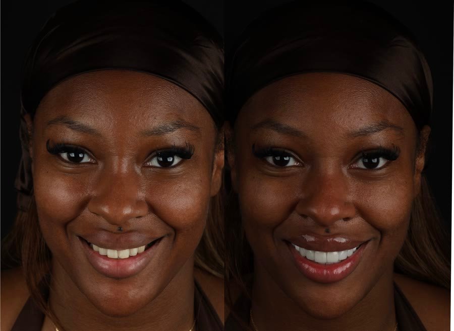 Real patient before and after porcelain veneers